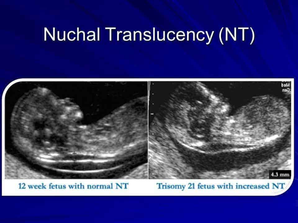 Siêu âm thai 3 tháng đầu có vai trò quan trọng để chẩn đoán các bất thường nhiễm sắc thể của thai nhi