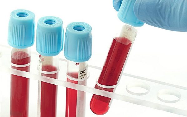 Xét nghiệm máu giúp phát hiện bệnh lây nhiễm qua đường tình dục
